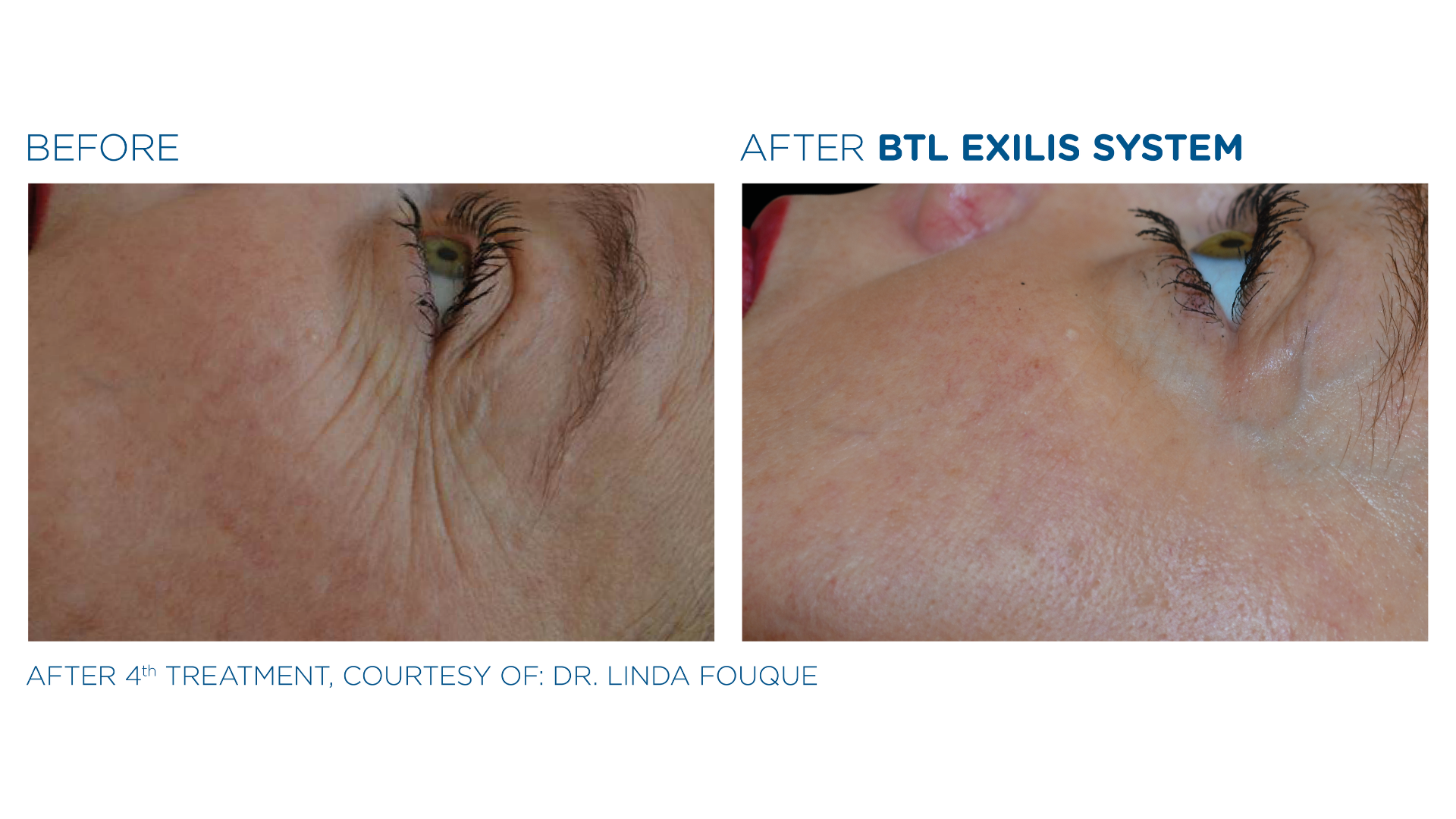 Before and After Exilis Ultra (1)