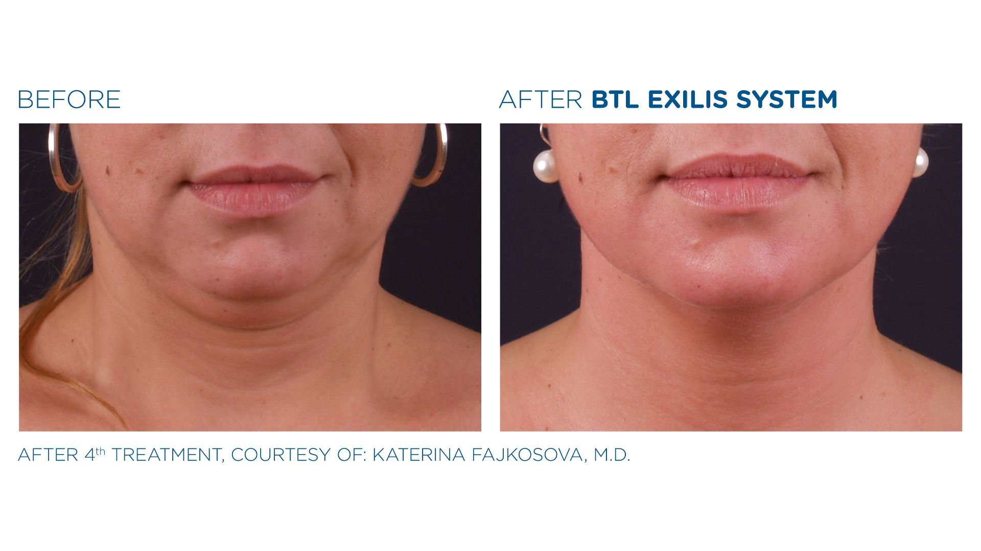 Before and After Exilis Ultra (2)