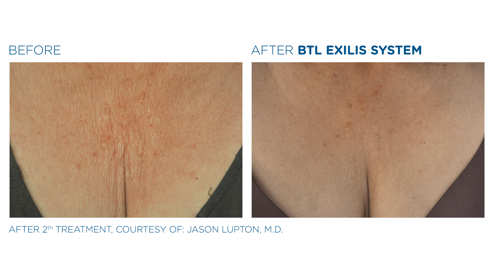 Before and After Exilis Ultra (3)