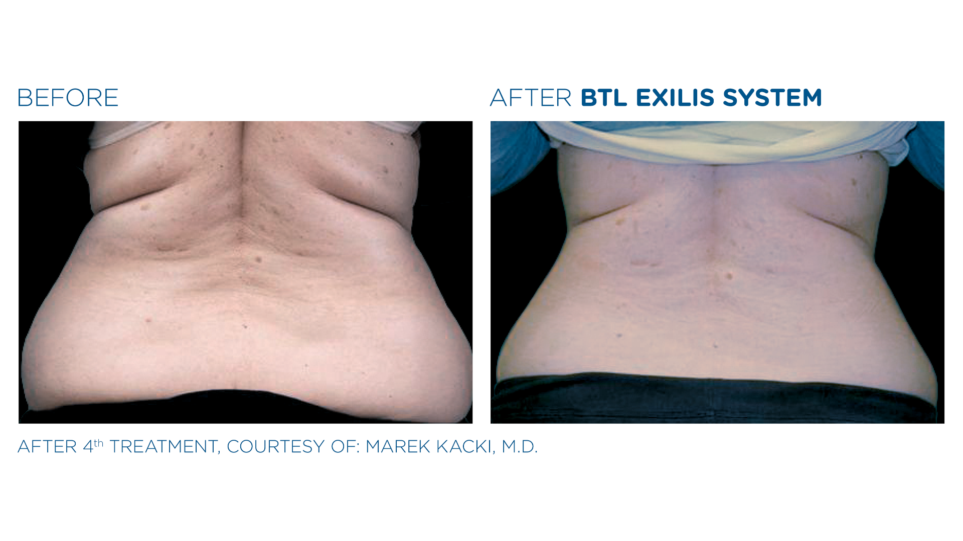 Before and After Exilis Ultra (4)