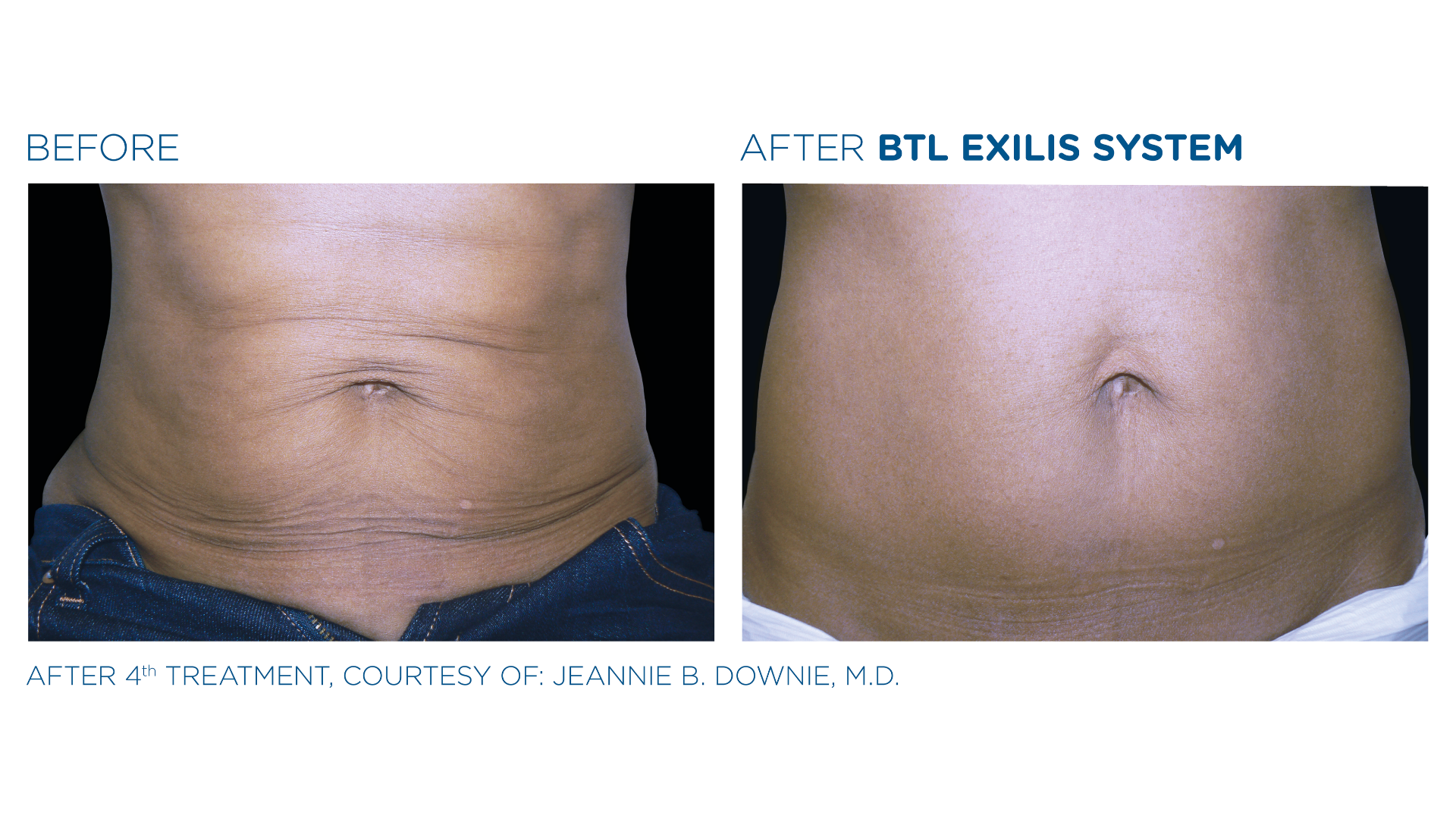 Before and After Exilis Ultra