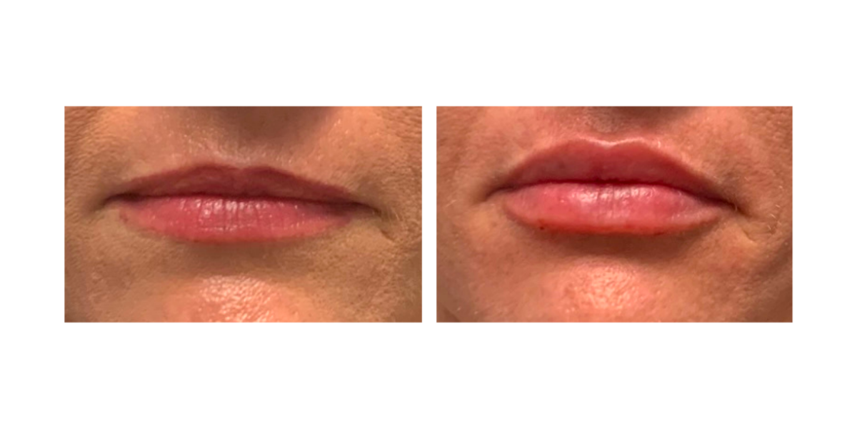 Before and After Fillers