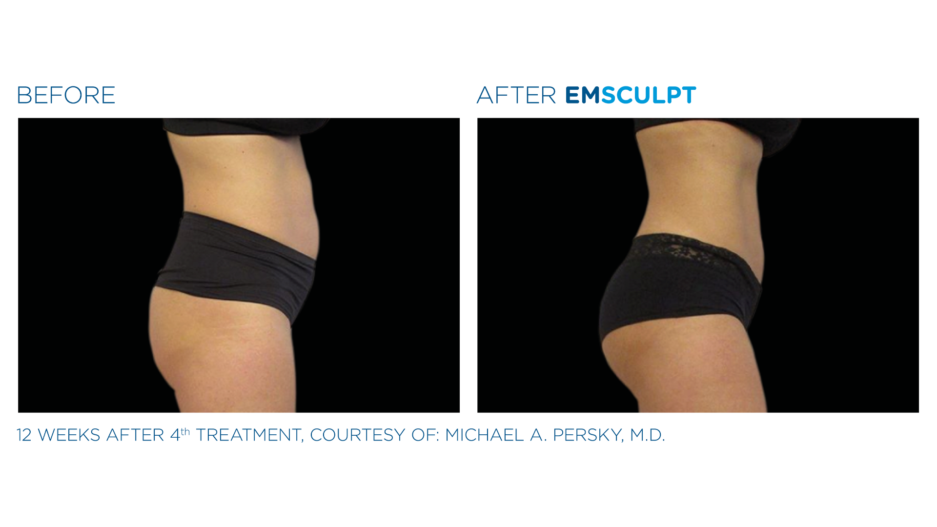 EmSculpt Before and After (1)