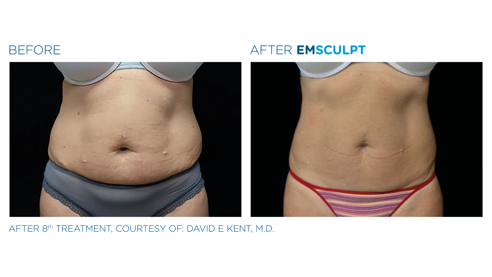 EmSculpt Before and After (2)