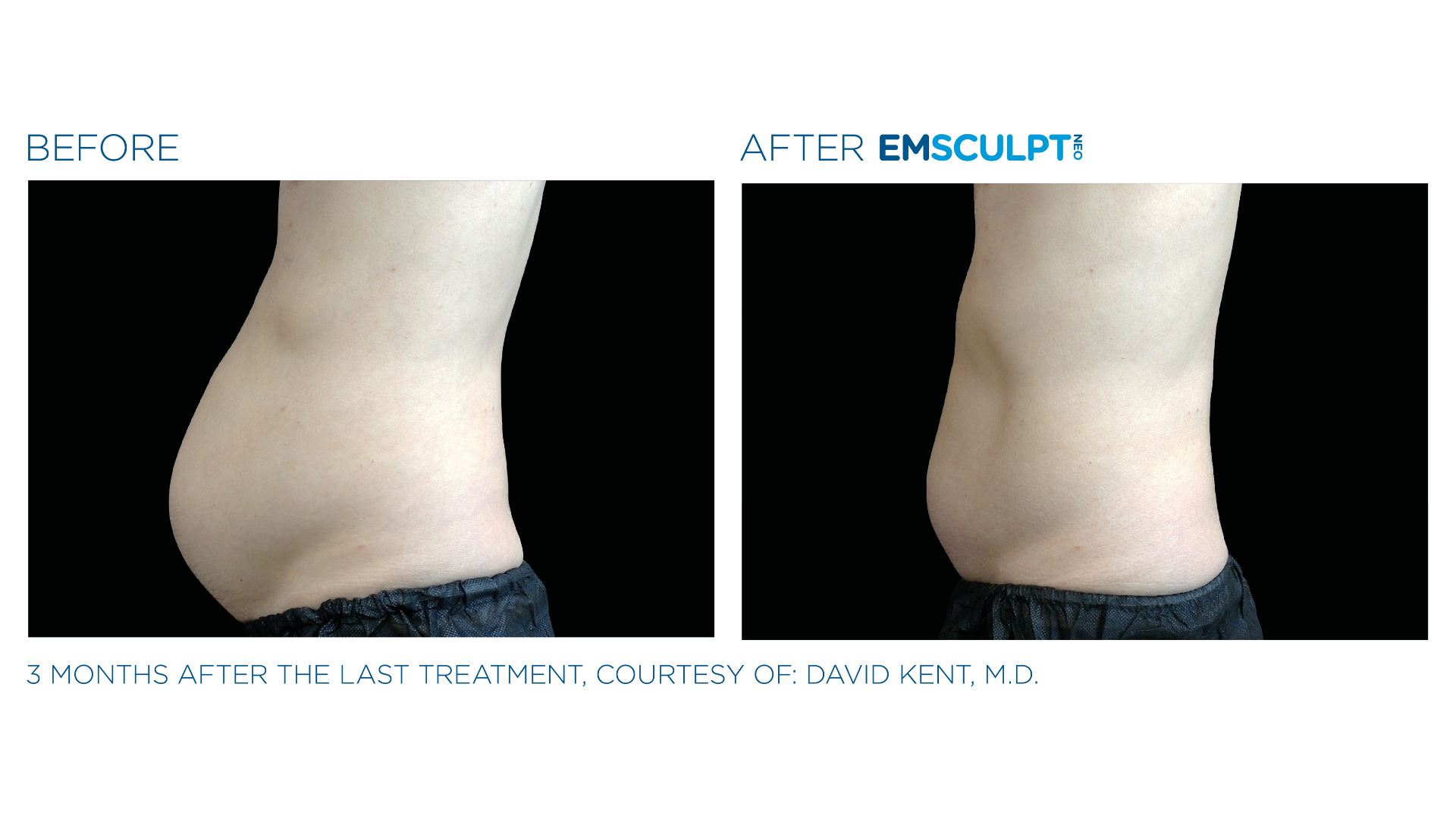 EmSculpt Before and After (3)