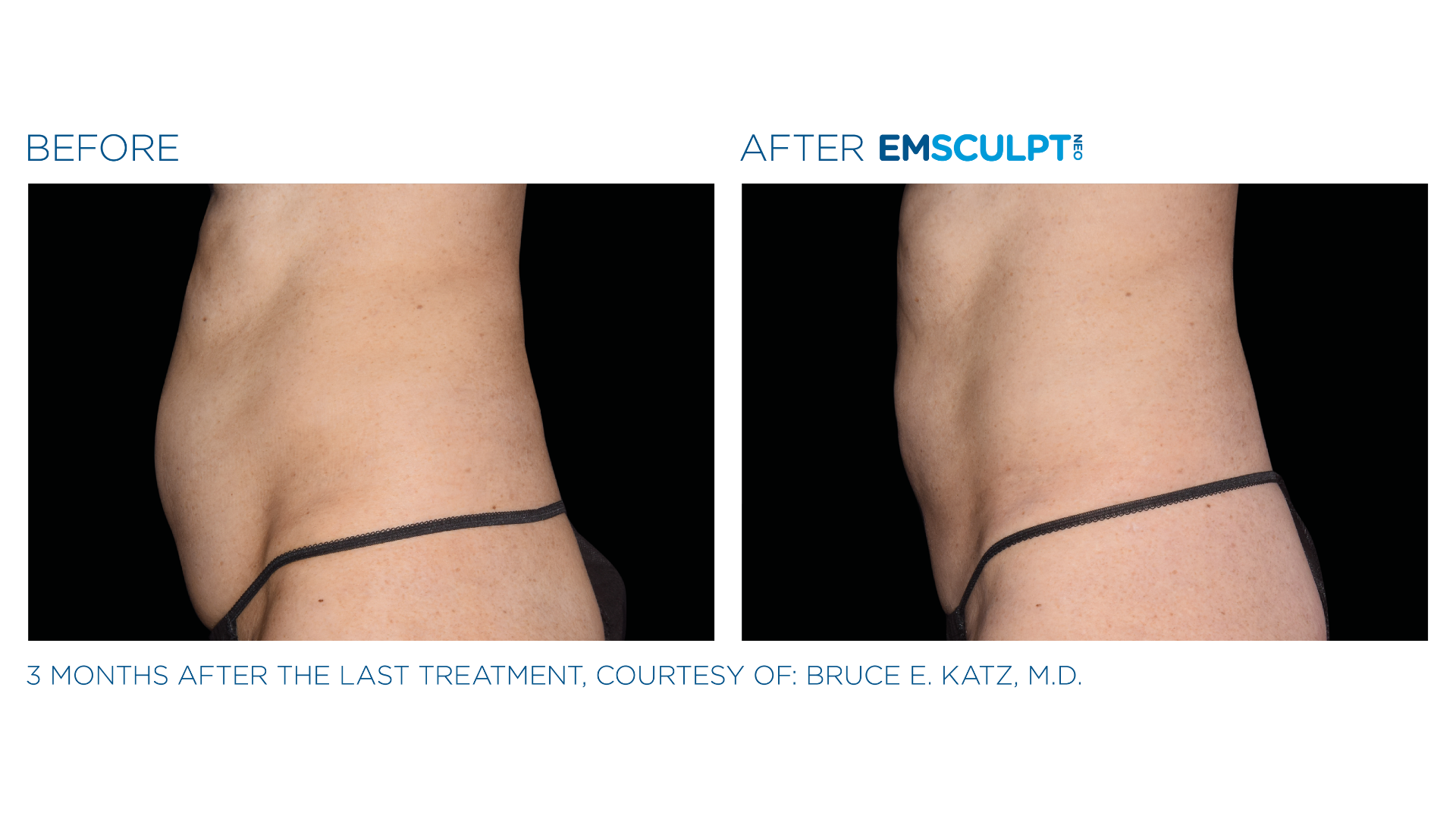 EmSculpt Before and After (4)