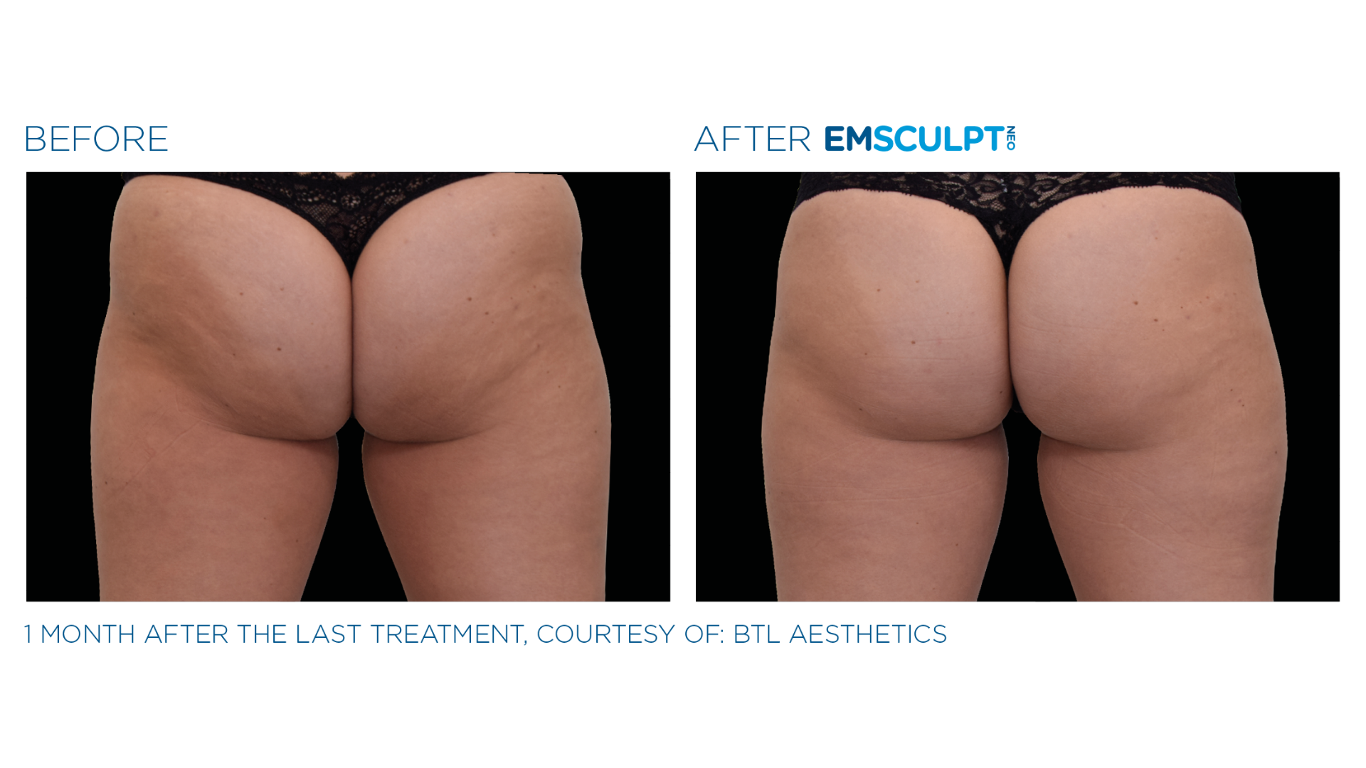 EmSculpt Before and After (5)