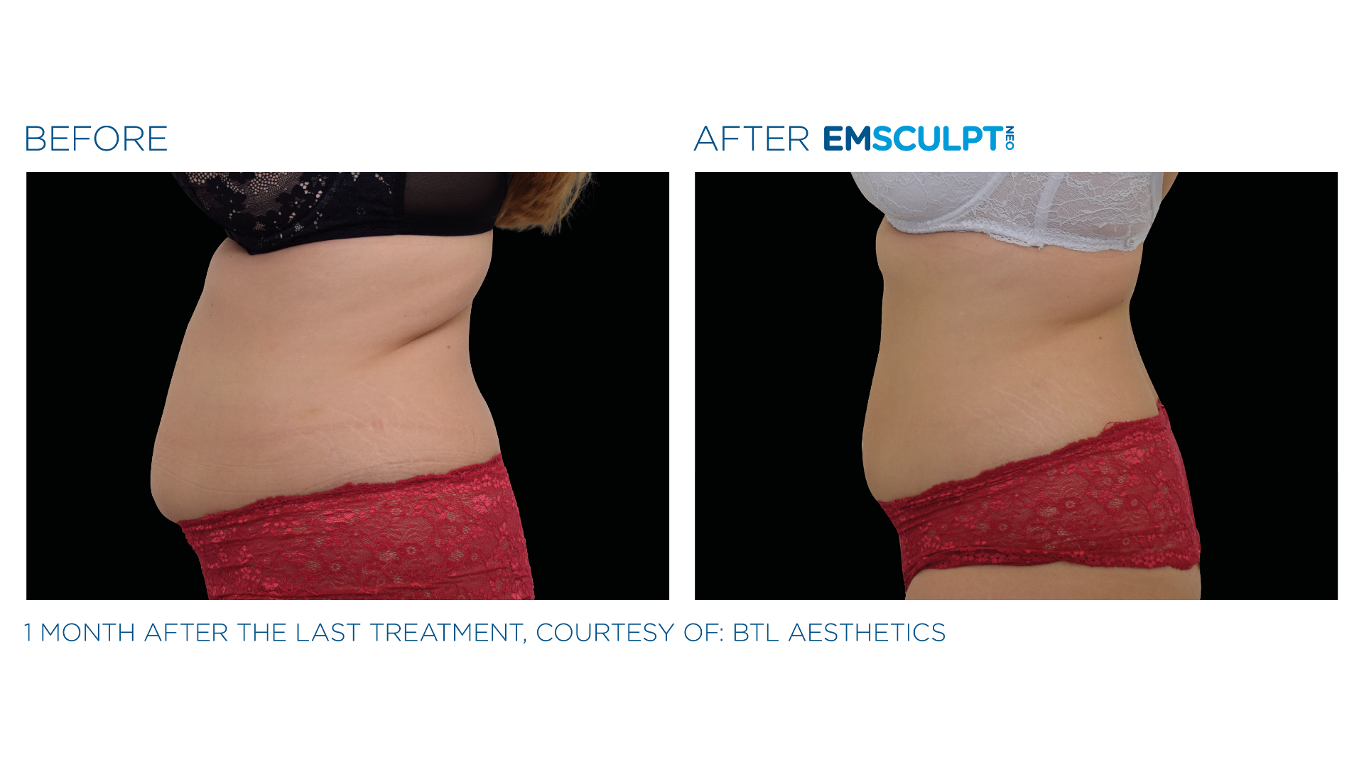 EmSculpt Before and After (6)