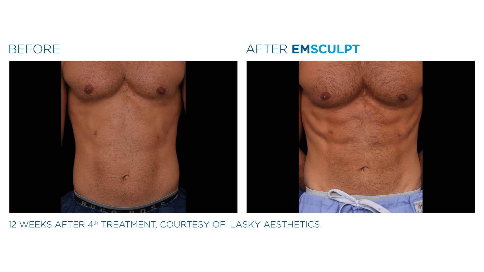 EmSculpt Before and After