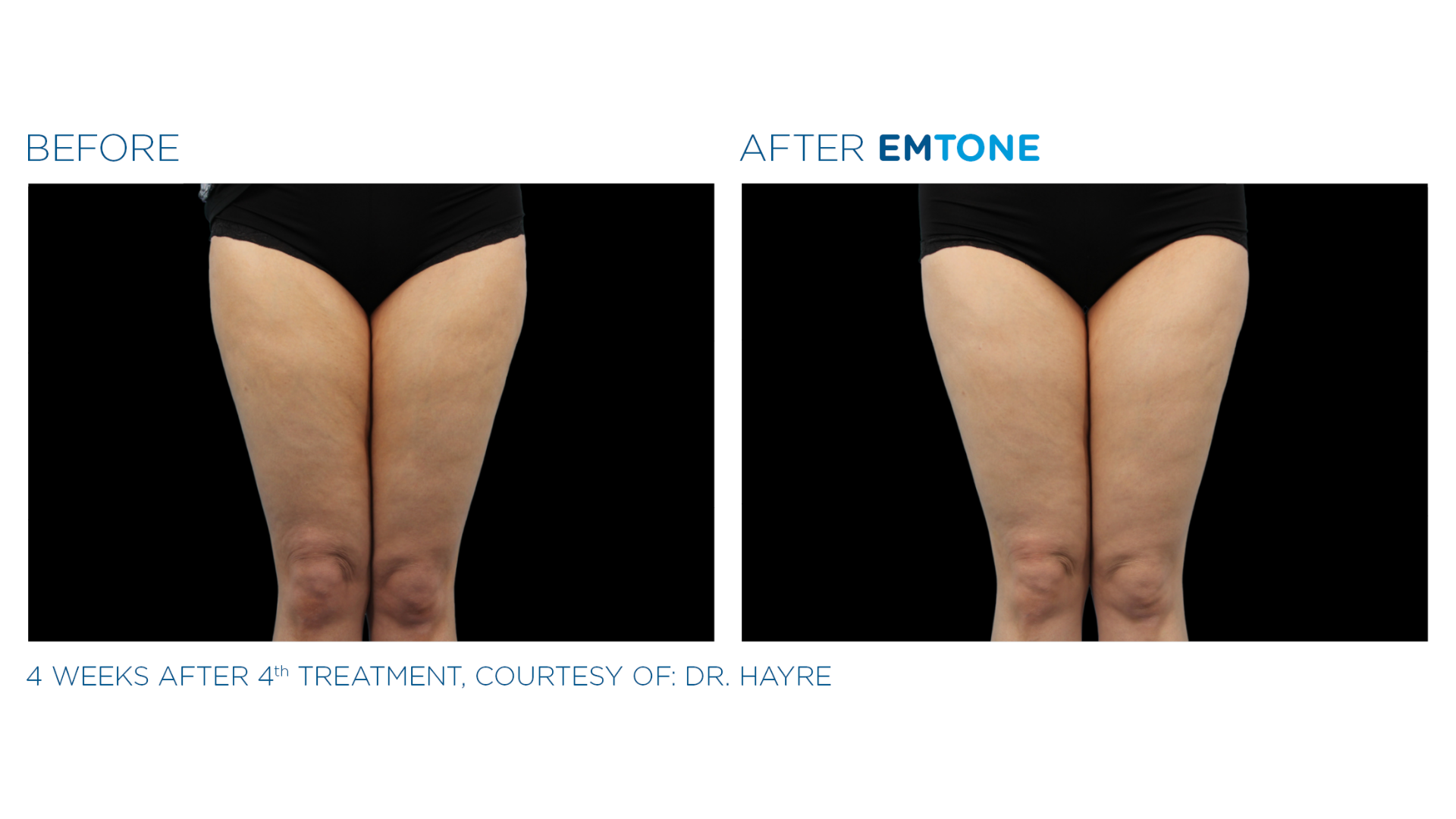 EmTone Before and After (3)
