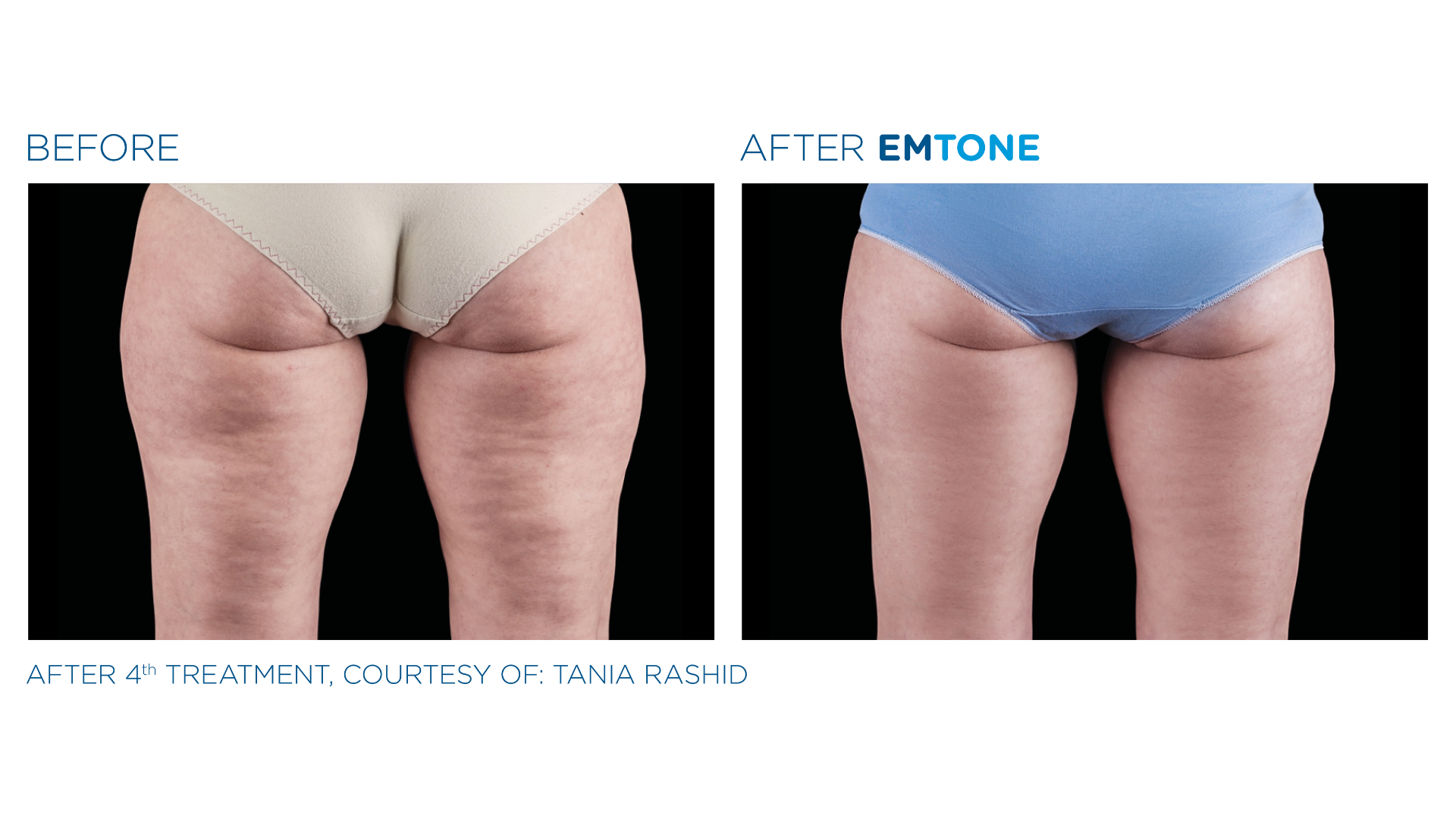 EmTone Before and After (4)