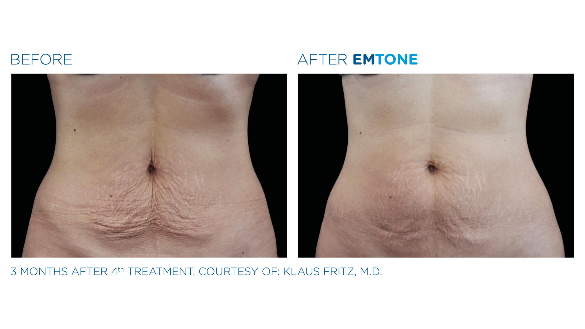 EmTone Before and After (5)
