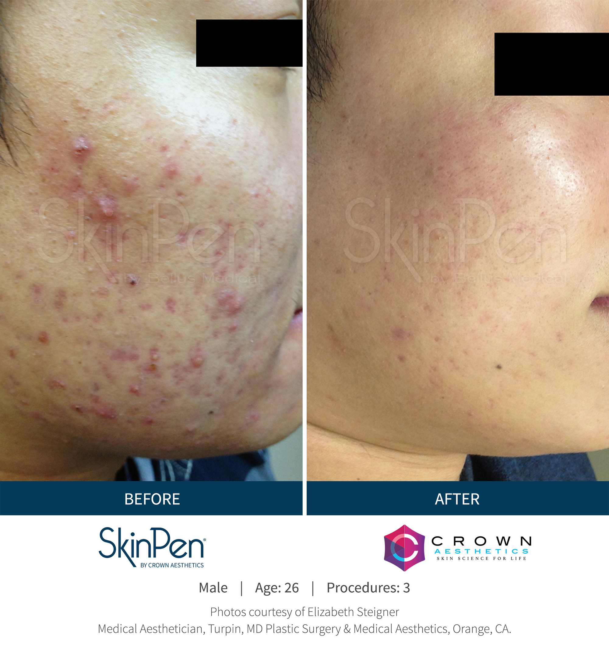 microneedling for acne