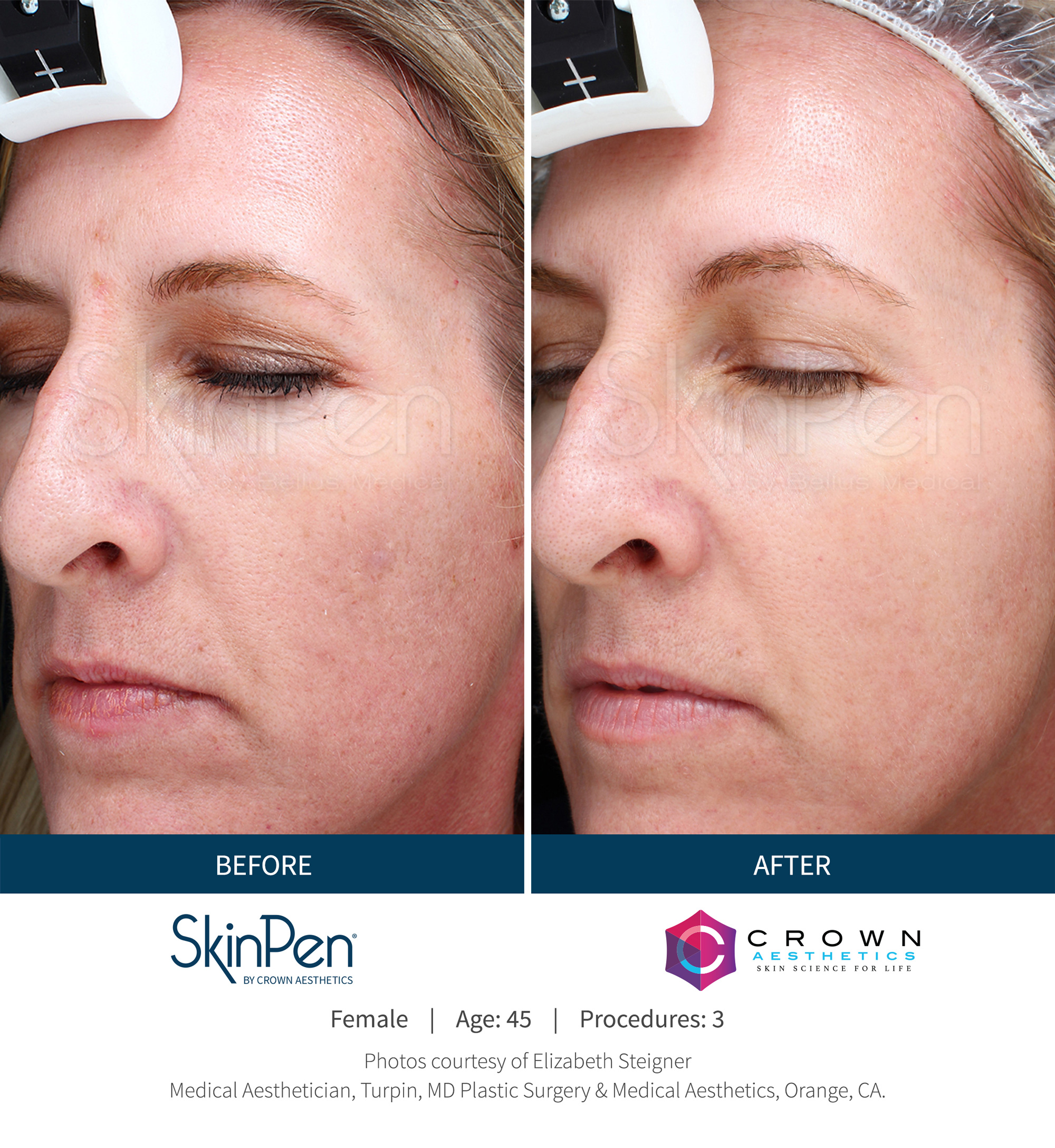 microneedling for scarring