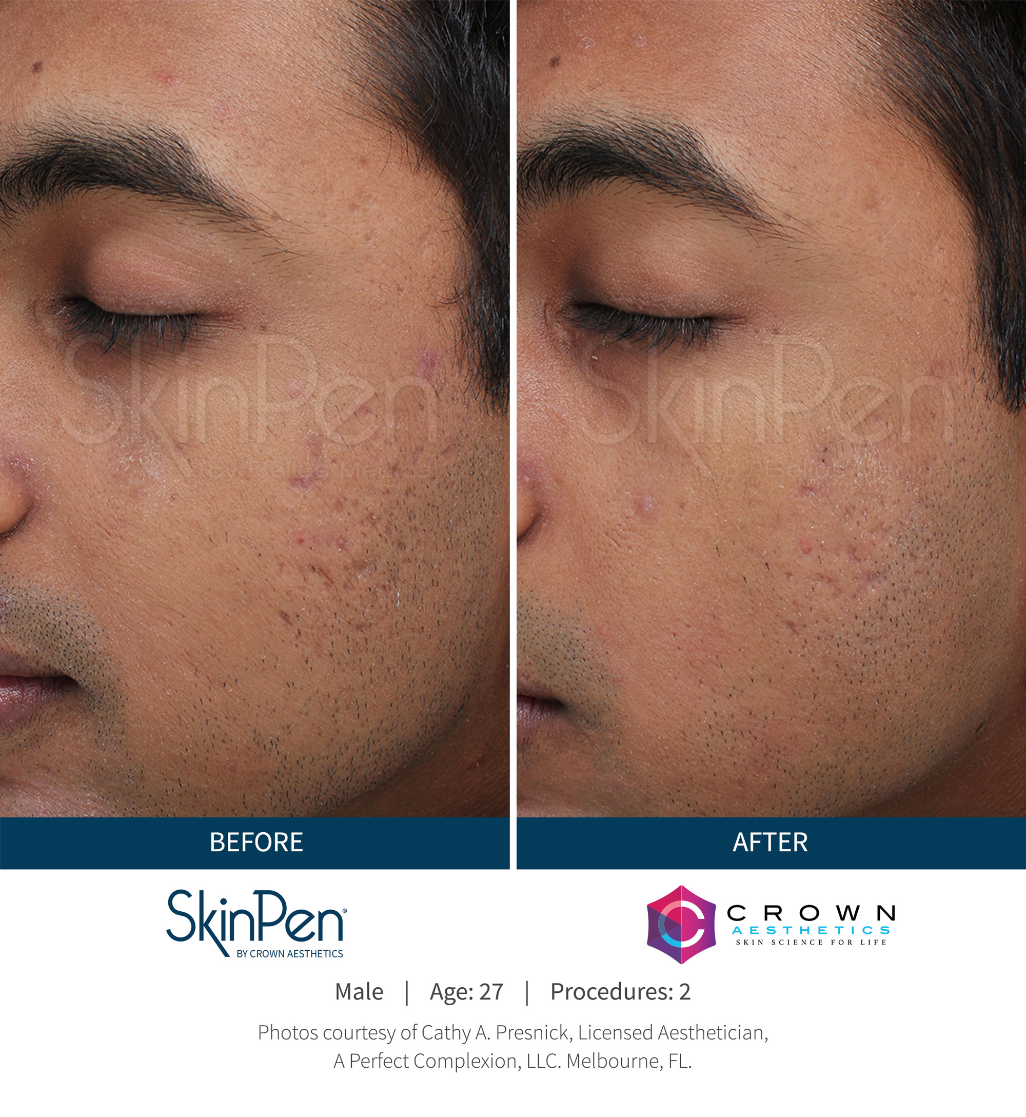 microneedling results