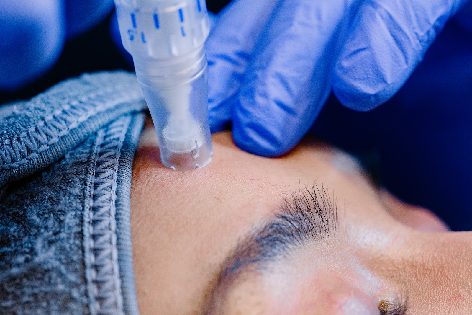 Microneedling for More Radiant, Smooth & Better-looking Skin