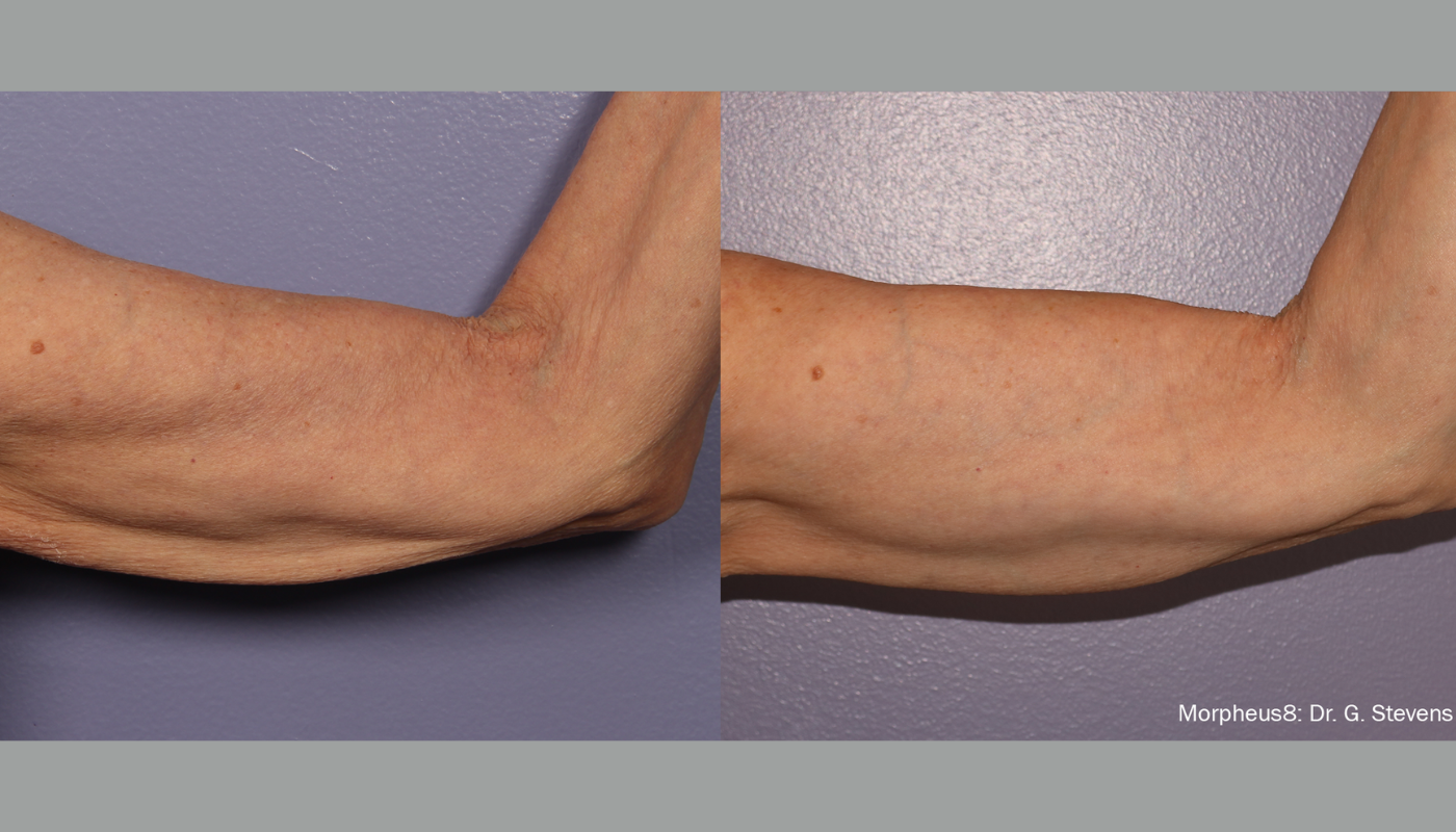 Reduce Arm Flab